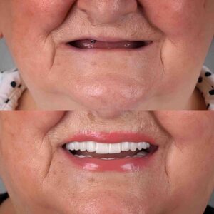 Full Mouth Dental Implants