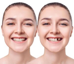 ToothImplant 300x260