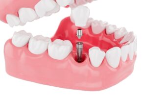 dental implant