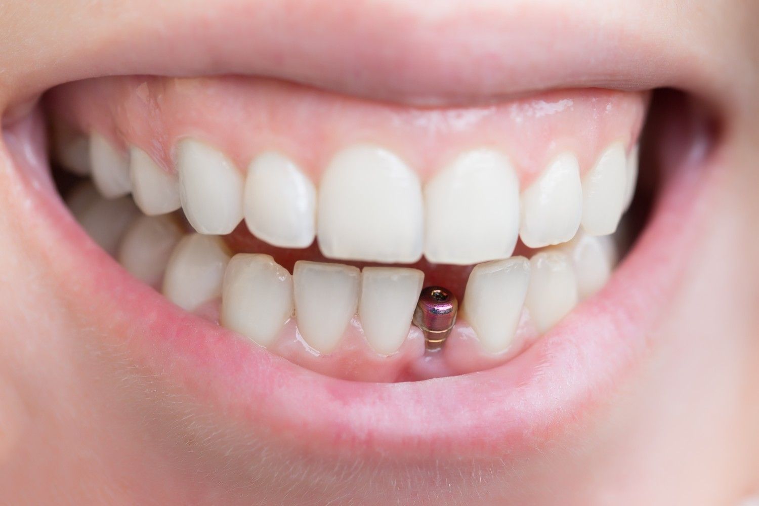 Pros and Cons of Implants: What You Should Know Before Saying Yes