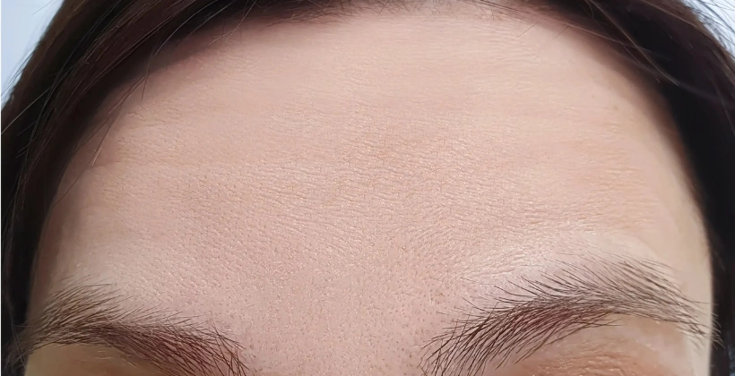 After Botulinum Treatment