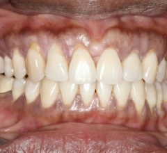 After Dental Implants 1