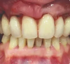 After Dental Implants