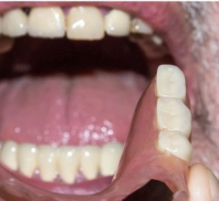 After Dentures Perfectsmile Dental 1