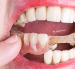 After Dentures Perfectsmile Dental