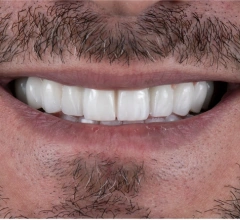 After Fillings 1