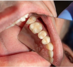 After Fillings