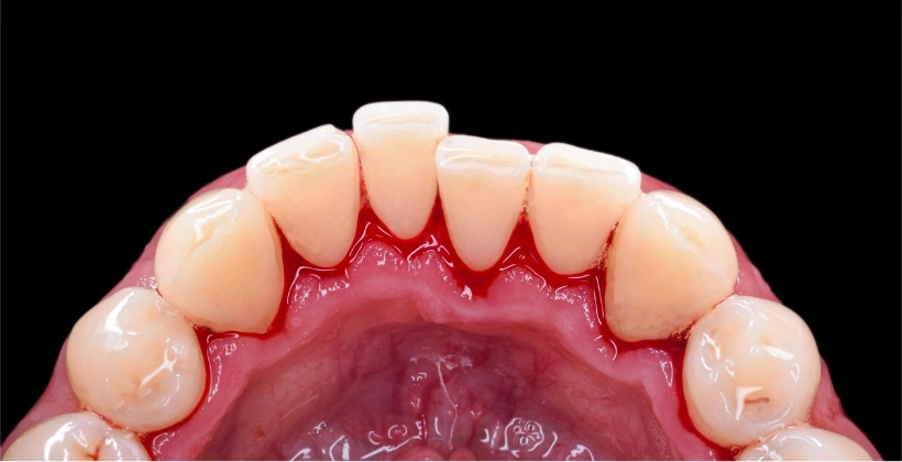 After Hygienist Treatment 1