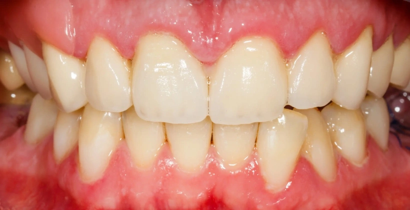 After Hygienist Treatment