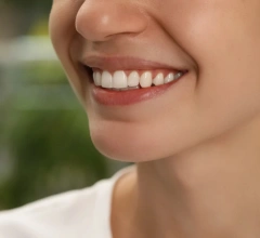 After Invisalign 1