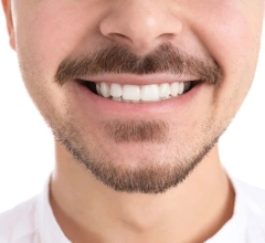 After Invisalign
