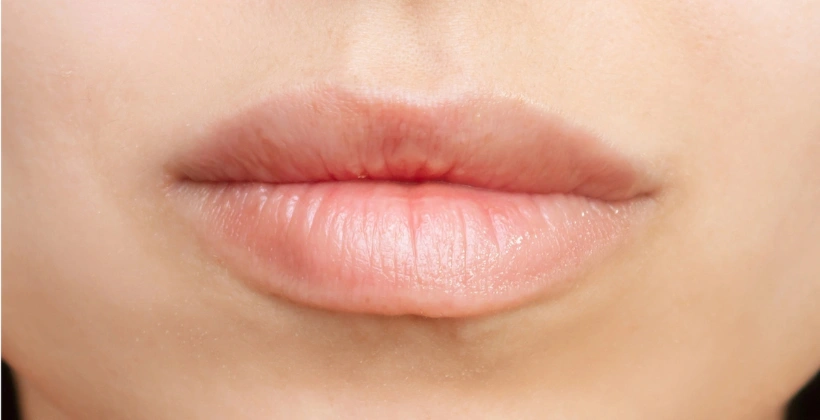 After Lip Filler Treatment 1