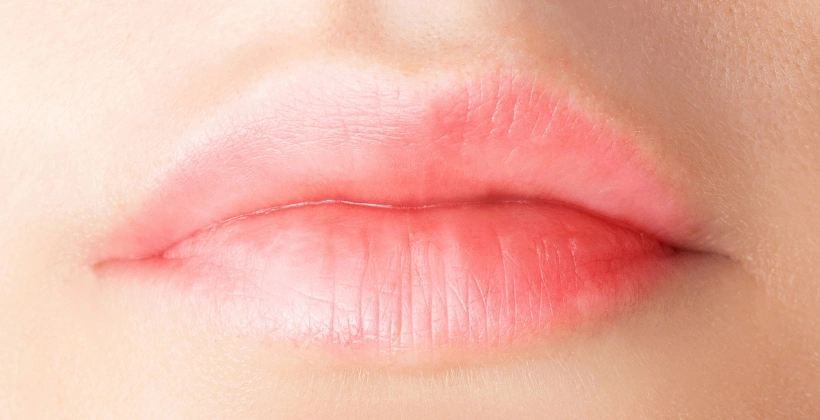 After Lip Filler Treatment