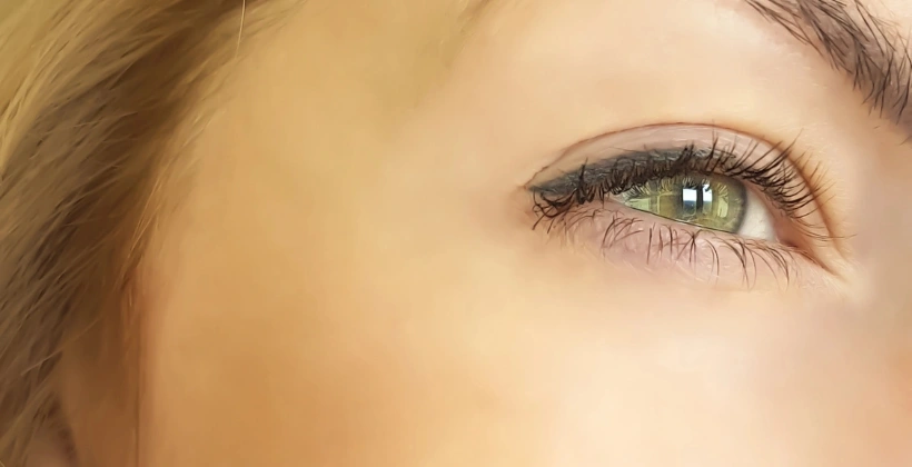 After Restylane Filler 1