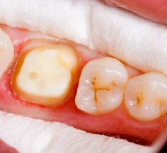 After Root Canal Treatments 1