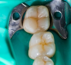 After Root Canal Treatments