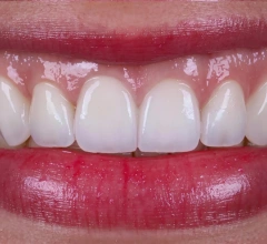 After whitening treatment 1