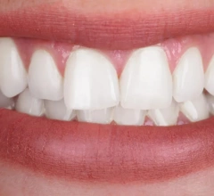 After whitening treatment