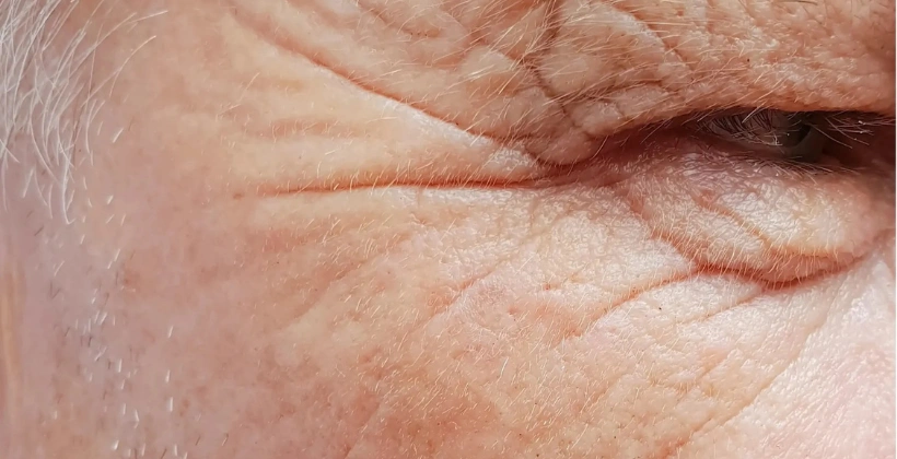 Before Botulinum Treatment 1