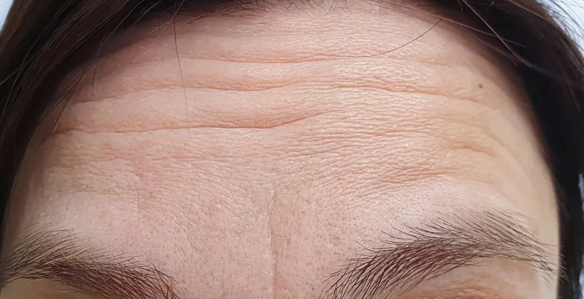 Before Botulinum Treatment