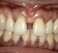 Before Dental Implants 1