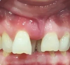 Before Dental Implants