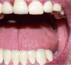 Before Dentures Perfectsmile Dental 1