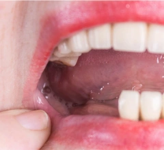 Before Dentures Perfectsmile Dental