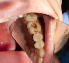 Before Fillings