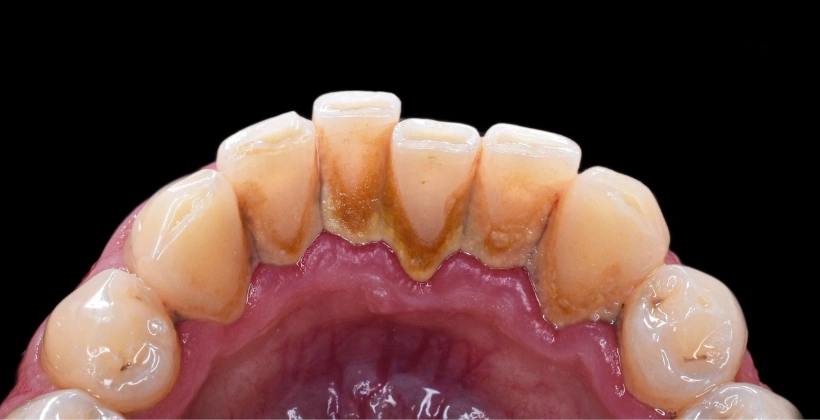 Before Hygienist Treatment 1
