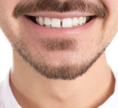 Before Invisalign