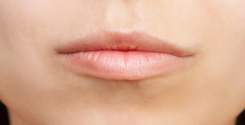 Before Lip Filler Treatment 1