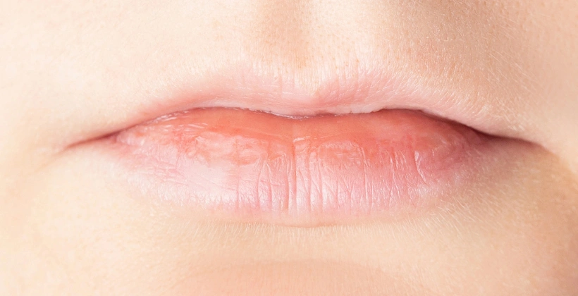 Before Lip Filler Treatment