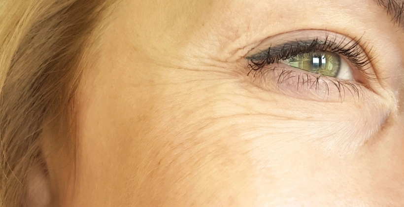 Before Restylane Filler 1
