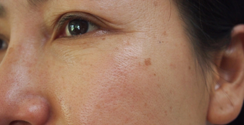 Before Restylane Filler