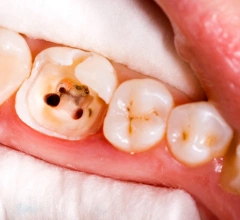 Before Root Canal Treatments 1