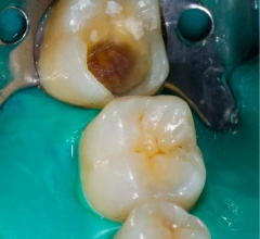 Before Root Canal Treatments
