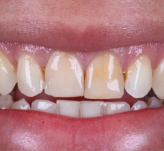 Before whitening treatment 1 1