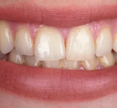 Before whitening treatment 1