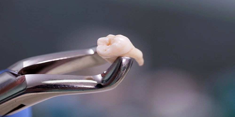When and Why do we Need Emergency Tooth Extraction
