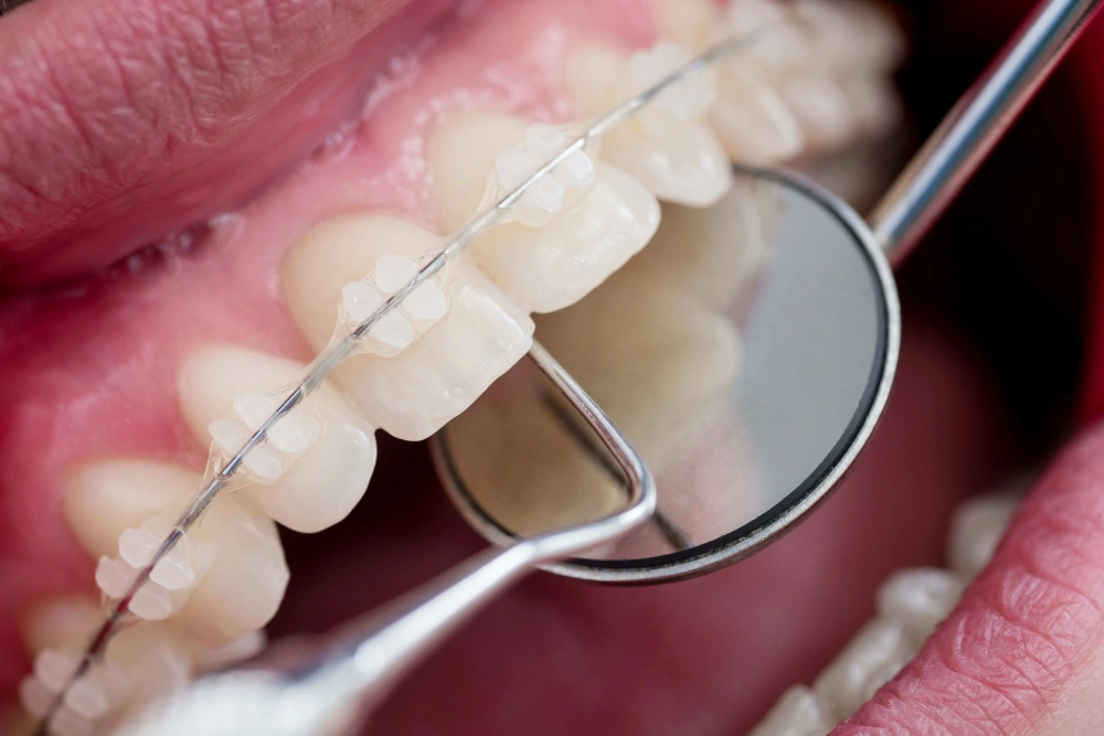 Ceramic Braces - PSD