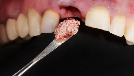 Clearing Infection