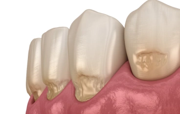 Exposed Tooth Roots
