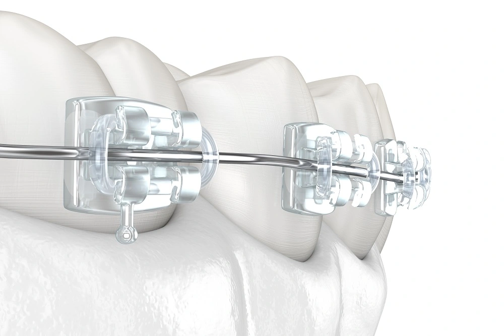 dental brace cost
