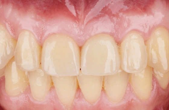 Implant offer a3