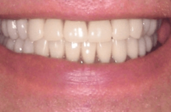 Implant offer a5 1