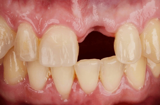 Implant offer b3 1