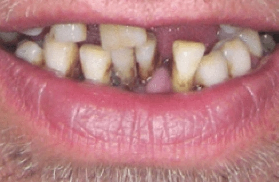 Implant offer b5 1