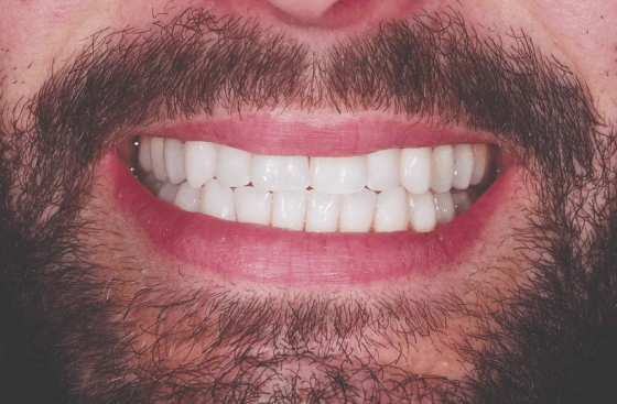 Invisalign offer a1