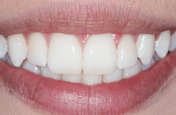 Invisalign offer a2